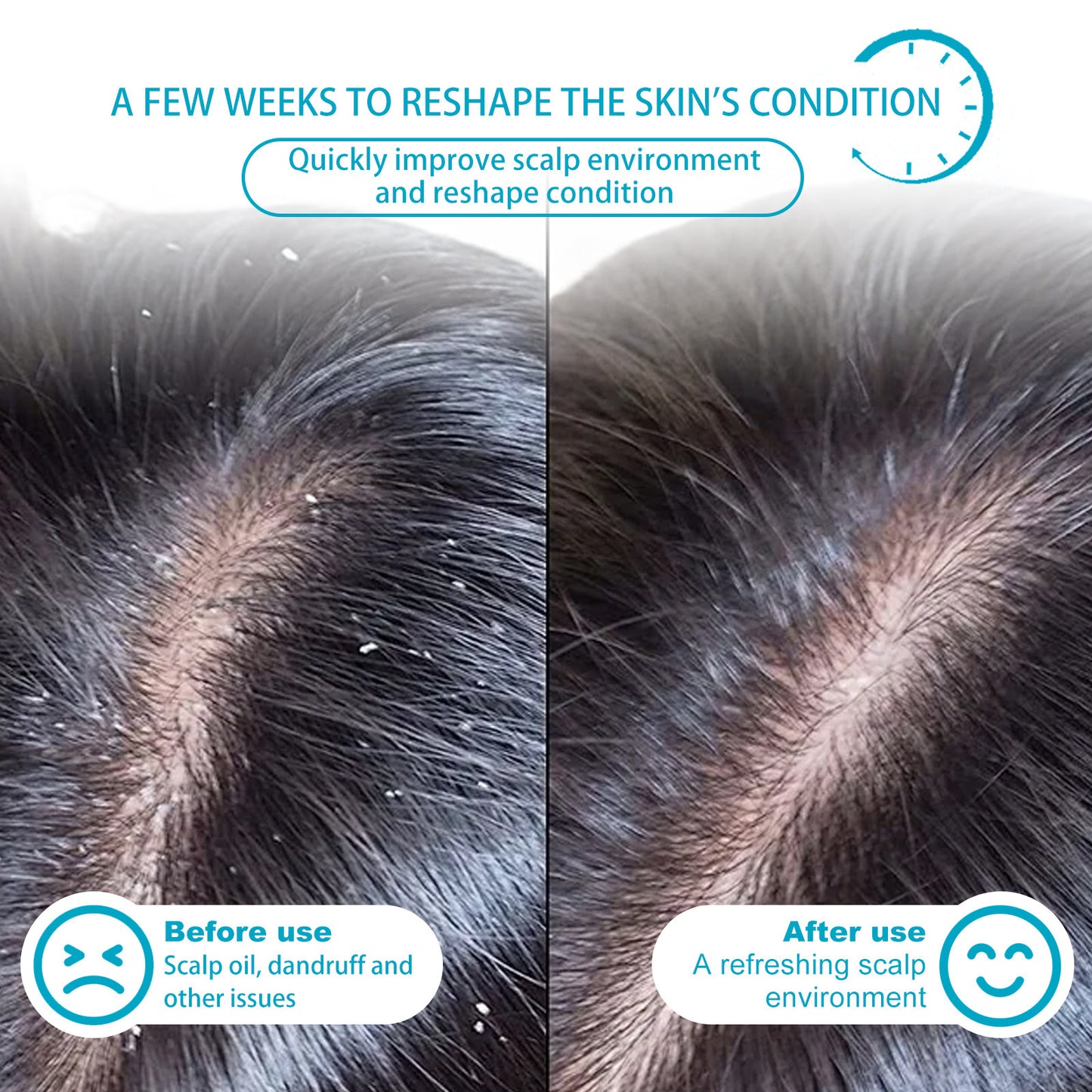 Seborrheic Dermatitis & Psoriasis Shampoo