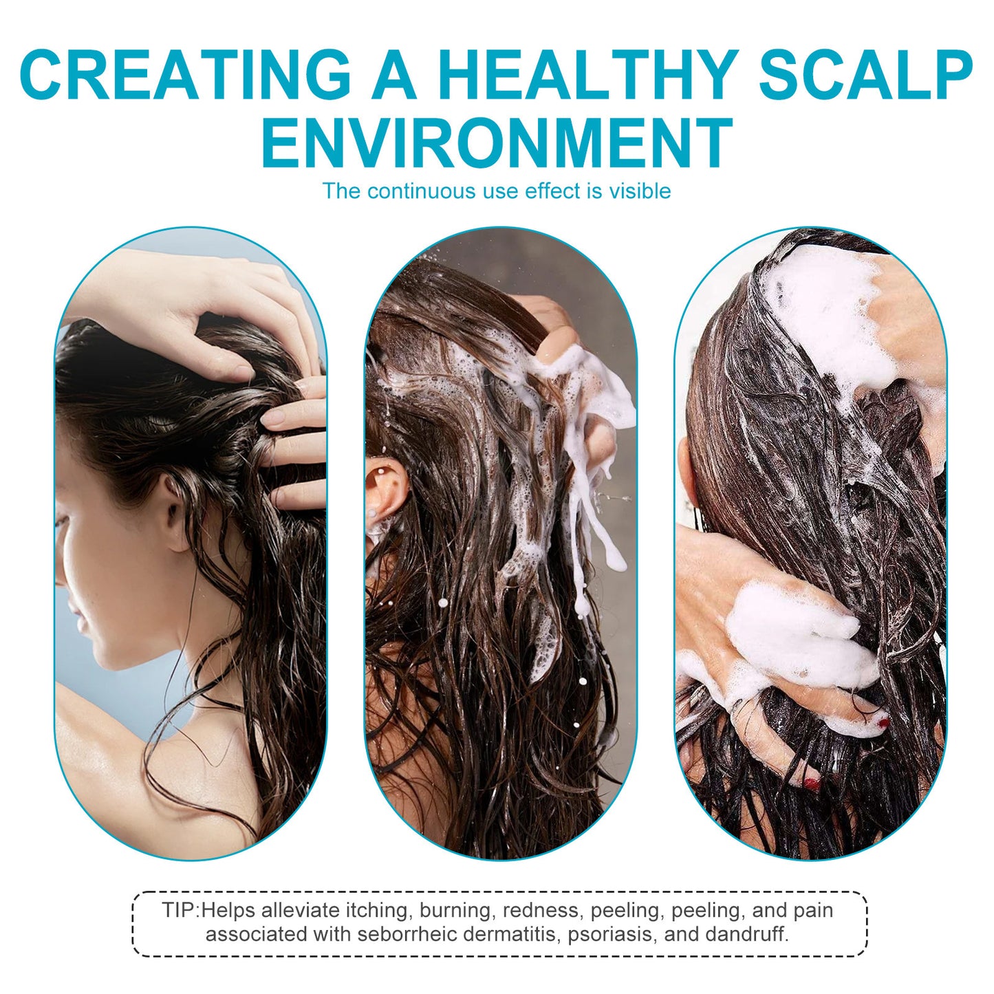 Seborrheic Dermatitis & Psoriasis Shampoo